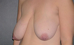 Breast Lift Before and After Pictures Plano, TX