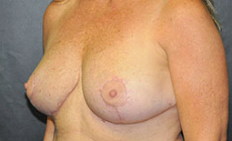 Breast Reduction Before and After Pictures Plano, TX