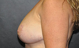 Breast Reduction Before and After Pictures Plano, TX