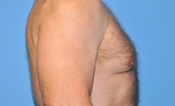 Gynecomastia Before and After Pictures Plano, TX