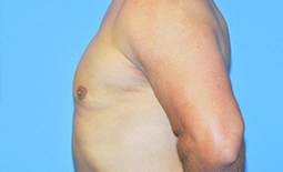 Gynecomastia Before and After Pictures Plano, TX