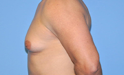 Gynecomastia Before and After Pictures Plano, TX