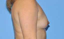Breast Augmentation Before and After Pictures Plano, TX