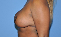 Breast Lift Before and After Pictures Plano, TX