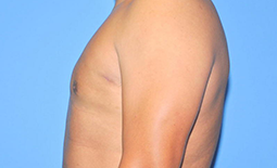 Gynecomastia Before and After Pictures Plano, TX