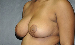 Breast Reduction Before and After Pictures Plano, TX