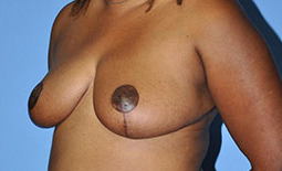 Breast Reduction Before and After Pictures Plano, TX