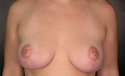 Breast Lift Before and After Pictures Plano, TX