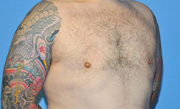 Gynecomastia Before and After Pictures Plano, TX