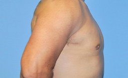 Gynecomastia Before and After Pictures Plano, TX