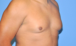 Gynecomastia Before and After Pictures Plano, TX