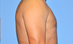 Gynecomastia Before and After Pictures Plano, TX