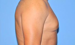 Gynecomastia Before and After Pictures Plano, TX