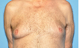 Gynecomastia Before and After Pictures Plano, TX