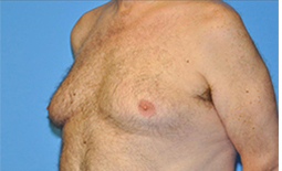 Gynecomastia Before and After Pictures Plano, TX