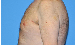 Gynecomastia Before and After Pictures Plano, TX