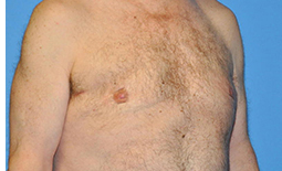 Gynecomastia Before and After Pictures Plano, TX