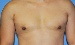 Gynecomastia Before and After Pictures Plano, TX