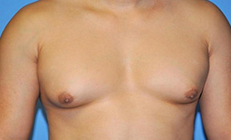 Gynecomastia Before and After Pictures Plano, TX