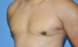 Gynecomastia Before and After Pictures Plano, TX