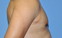 Gynecomastia Before and After Pictures Plano, TX