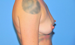 Breast Augmentation Before and After Pictures Plano, TX