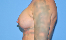 Breast Augmentation Before and After Pictures Plano, TX