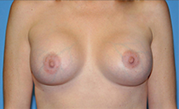 Breast Augmentation Before and After Pictures Plano, TX