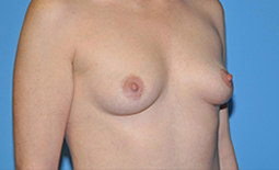 Breast Augmentation Before and After Pictures Plano, TX