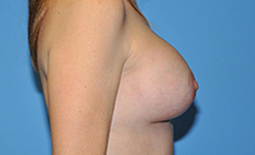 Breast Augmentation Before and After Pictures Plano, TX