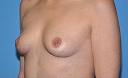 Breast Augmentation Before and After Pictures Plano, TX