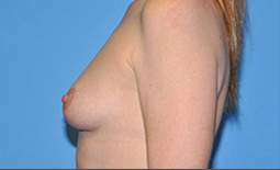 Breast Augmentation Before and After Pictures Plano, TX