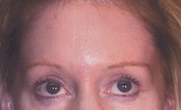 Blepharoplasty Before and After Pictures Plano, TX