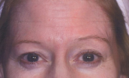 Blepharoplasty Before and After Pictures Plano, TX