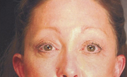 Blepharoplasty Before and After Pictures Plano, TX