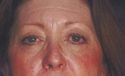 Blepharoplasty Before and After Pictures Plano, TX