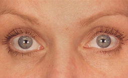 Blepharoplasty Before and After Pictures Plano, TX