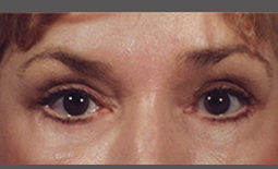 Blepharoplasty Before and After Pictures Plano, TX