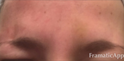 Botox® Before and After Pictures Plano, TX