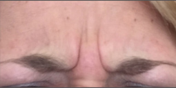 Botox® Before and After Pictures Plano, TX