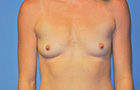 Breast Augmentation Before and After Pictures Plano, TX