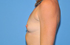 Breast Augmentation Before and After Pictures Plano, TX