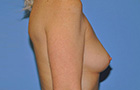 Breast Augmentation Before and After Pictures Plano, TX