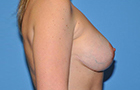 Breast Lift Before and After Pictures Plano, TX