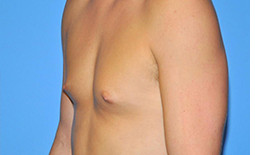 Gynecomastia Before and After Pictures Plano, TX