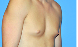 Gynecomastia Before and After Pictures Plano, TX