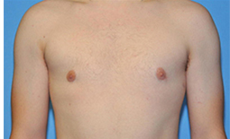 Gynecomastia Before and After Pictures Plano, TX