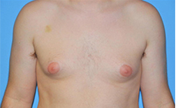 Gynecomastia Before and After Pictures Plano, TX