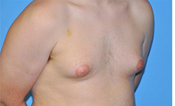 Gynecomastia Before and After Pictures Plano, TX