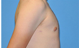 Gynecomastia Before and After Pictures Plano, TX